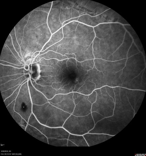 Chronic BRAO with Hemorrhages  - Sclerosed Vessel
95 year old female with blurred vision in both eyes in for a checkup.  History of perpapillary CNVM in the left eye 2 years prior not treated. History of stroke with multiple emboli 1 year ago.
Vision 20/32 OD, 20/40 OS
