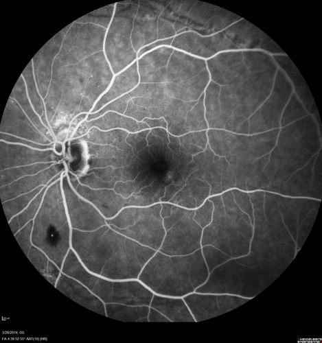 Chronic BRAO with Hemorrhages  - Sclerosed Vessel
95 year old female with blurred vision in both eyes in for a checkup.  History of perpapillary CNVM in the left eye 2 years prior not treated. History of stroke with multiple emboli 1 year ago.
Vision 20/32 OD, 20/40 OS
