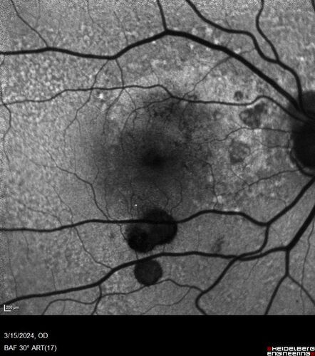 Fresh BRAO in patient with wet AMD
91 year old female  She noticed last night a shadow over the left eye. When she closes her right eye she cannot see the bottom of the vision in the left eye. This is new.
VA OD: sc20/32-1
VA OS: sc20/32-2
