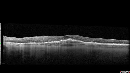 Fresh BRAO in patient with wet AMD
91 year old female  She noticed last night a shadow over the left eye. When she closes her right eye she cannot see the bottom of the vision in the left eye. This is new.
VA OD: sc20/32-1
VA OS: sc20/32-2
