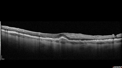 Fresh BRAO in patient with wet AMD
91 year old female  She noticed last night a shadow over the left eye. When she closes her right eye she cannot see the bottom of the vision in the left eye. This is new.
VA OD: sc20/32-1
VA OS: sc20/32-2
