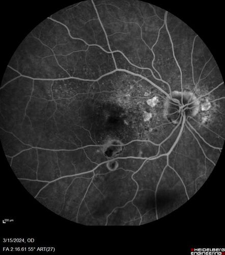 Fresh BRAO in patient with wet AMD
91 year old female  She noticed last night a shadow over the left eye. When she closes her right eye she cannot see the bottom of the vision in the left eye. This is new.
VA OD: sc20/32-1
VA OS: sc20/32-2
