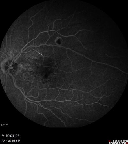 Fresh BRAO in patient with wet AMD
91 year old female  She noticed last night a shadow over the left eye. When she closes her right eye she cannot see the bottom of the vision in the left eye. This is new.
VA OD: sc20/32-1
VA OS: sc20/32-2
