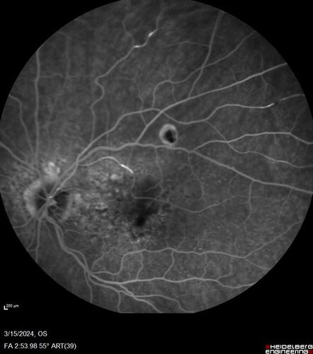 Fresh BRAO in patient with wet AMD
91 year old female  She noticed last night a shadow over the left eye. When she closes her right eye she cannot see the bottom of the vision in the left eye. This is new.
VA OD: sc20/32-1
VA OS: sc20/32-2
