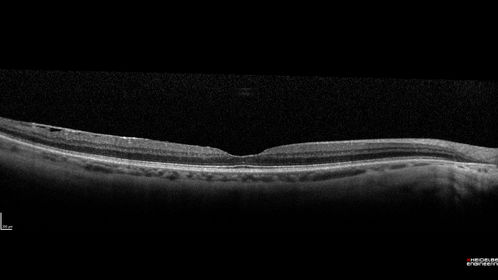 Branch Retinal Artery Occlusion - No Plaque
74 year old man with 2 days of vision loss.  Vision OS is 20/200 but improved to 20/25 in 1 month.  He has dysfibrinogen anemia.
