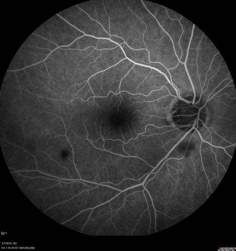 Branch Retinal Artery Occlusion - No Plaque
74 year old man with 2 days of vision loss.  Vision OS is 20/200 but improved to 20/25 in 1 month.  He has dysfibrinogen anemia.
