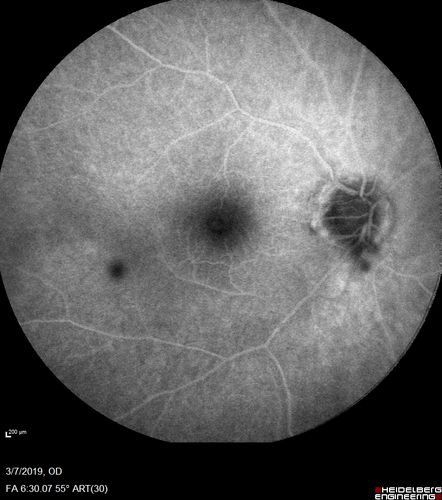 Branch Retinal Artery Occlusion - No Plaque
74 year old man with 2 days of vision loss.  Vision OS is 20/200 but improved to 20/25 in 1 month.  He has dysfibrinogen anemia.
