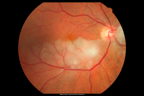Branch Retinal Artery Occlusion
Acute Inferotemporal Occlusion Right Eye - FA shows delayed circulation, OCT shows edema of superficial layers of retina
