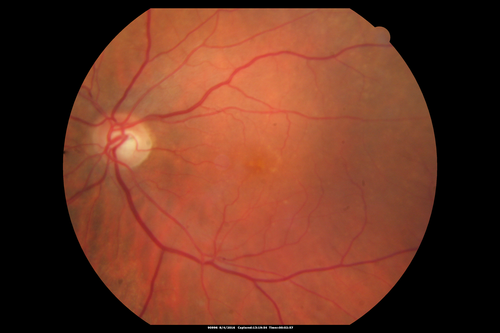 Branch Retinal Artery Occlusion
Acute Inferotemporal Occlusion Right Eye - FA shows delayed circulation, OCT shows edema of superficial layers of retina
