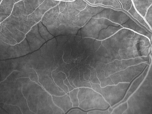 Branch Retinal Arterial Occlusion 20/20 Vision - Symptoms for 1 Day
