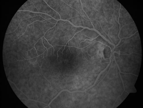 Branch Retinal Arterial Occlusion 20/20 Vision - Symptoms for 1 Day
75-year-old man was seen in the office on 4/6/2010.  He noticed a sudden vision change in the right eye yesterday morning.  20/20 Vision both Eyes

