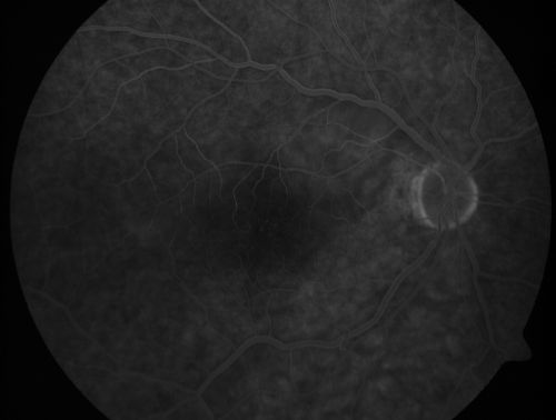 Branch Retinal Arterial Occlusion 20/20 Vision - Symptoms for 1 Day
75-year-old man was seen in the office on 4/6/2010.  He noticed a sudden vision change in the right eye yesterday morning.  20/20 Vision both Eyes

