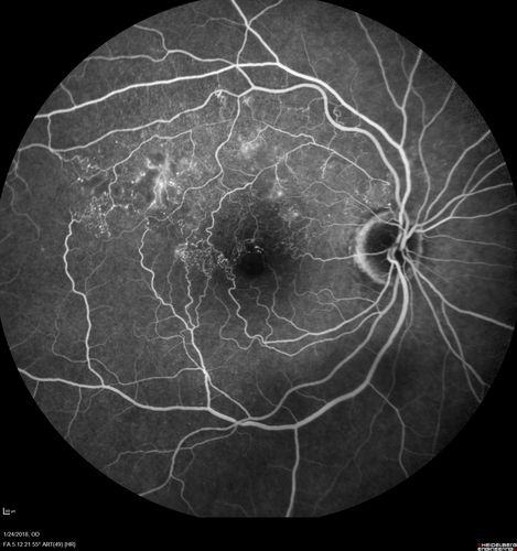 Vascular Remodeling Bilateral BRVO
85 year old female 20/25 OU with BRVO 7 years ago in both eyes.  She has a change in vision.  The FA shows extensive collaterallization and vascular remodeling in each macula.

