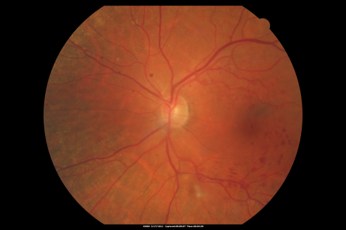 Macular Branch Retinal Vein Occlusions (2) Left Eye - No Macular Edema (yet) 
77-year-old woman with two macular branch retinal vein occlusions in the left eye  OD 20/25

