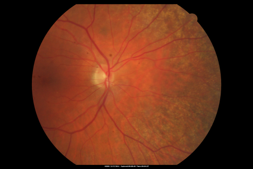 Macular Branch Retinal Vein Occlusions (2) Left Eye - No Macular Edema (yet) 
77-year-old woman with two macular branch retinal vein occlusions in the left eye  OD 20/25
