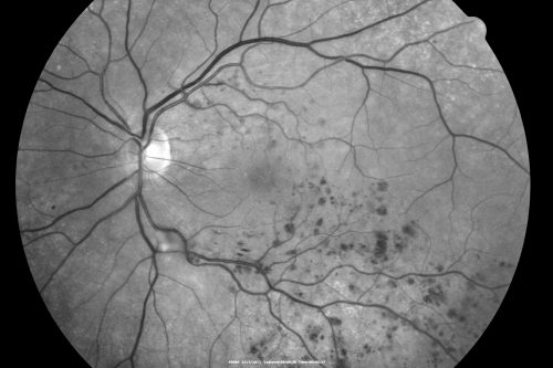 Macular Branch Retinal Vein Occlusions (2) Left Eye - No Macular Edema (yet) 
77-year-old woman with two macular branch retinal vein occlusions in the left eye  OD 20/25
