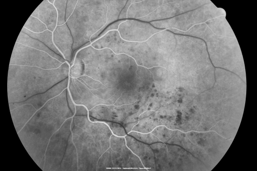 Macular Branch Retinal Vein Occlusions (2) Left Eye - No Macular Edema (yet) 
77-year-old woman with two macular branch retinal vein occlusions in the left eye  OD 20/25
