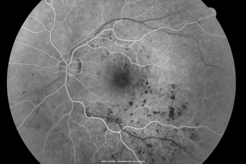 Macular Branch Retinal Vein Occlusions (2) Left Eye - No Macular Edema (yet) 
77-year-old woman with two macular branch retinal vein occlusions in the left eye  OD 20/25
