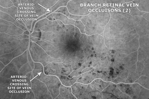 Macular Branch Retinal Vein Occlusions (2) Left Eye - No Macular Edema (yet) 
77-year-old woman with two macular branch retinal vein occlusions in the left eye  OD 20/25
