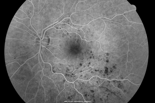 Macular Branch Retinal Vein Occlusions (2) Left Eye - No Macular Edema (yet) 
77-year-old woman with two macular branch retinal vein occlusions in the left eye  OD 20/25
