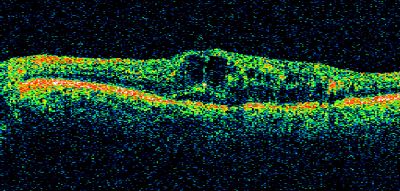 brvo cme with small serous macular detachment 
70 year old woman with 20/80 vision from a branch retinal vein occlusion and macular edema.  She has had laser treatment and intravitreal steroids.  Her vision with further laser improved to 20/50.
Keywords: branch retinal vein occlusion; macular edema; collateral vessels; exudate
