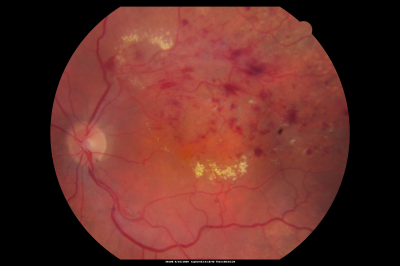 branch retinal vein occlusion - fundus photo
70 year old woman with 20/80 vision from a branch retinal vein occlusion and macular edema.  She has had laser treatment and intravitreal steroids.  Her vision with further laser improved to 20/50.
Keywords: branch retinal vein occlusion; macular edema; collateral vessels; exudate