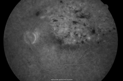 branch retinal vein occlusion - fluorescein angiogram
70 year old woman with 20/80 vision from a branch retinal vein occlusion and macular edema.  She has had laser treatment and intravitreal steroids.  Her vision with further laser improved to 20/50.
Keywords: branch retinal vein occlusion; macular edema; collateral vessels; exudate