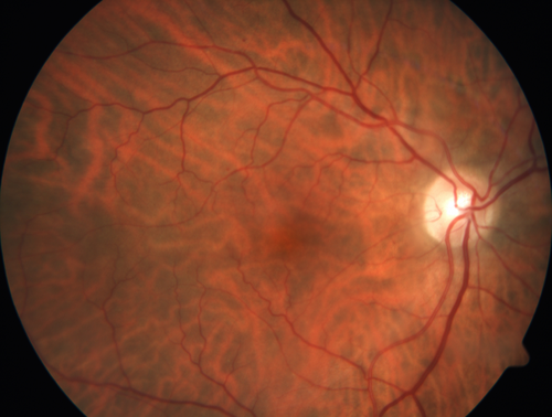 Branch Retinal Vein Occlusion (BRVO) no macular edema - cotton wool spot
85 year old man with asymptomatic BRVO - his vision stayed great without needing any treatment.
