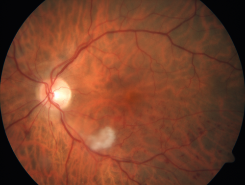 Branch Retinal Vein Occlusion (BRVO) no macular edema - cotton wool spot
85 year old man with asymptomatic BRVO - his vision stayed great without needing any treatment.
