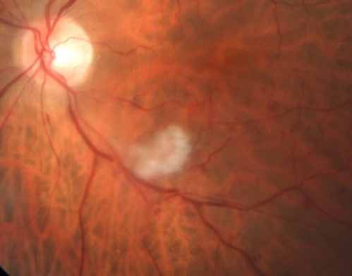 Branch Retinal Vein Occlusion (BRVO) no macular edema - cotton wool spot
85 year old man with asymptomatic BRVO - his vision stayed great without needing any treatment.
