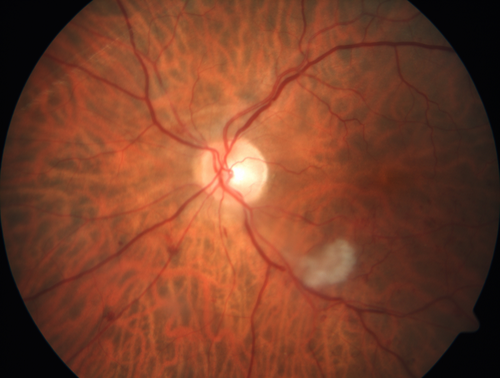 Branch Retinal Vein Occlusion (BRVO) no macular edema - cotton wool spot
85 year old man with asymptomatic BRVO - his vision stayed great without needing any treatment.

