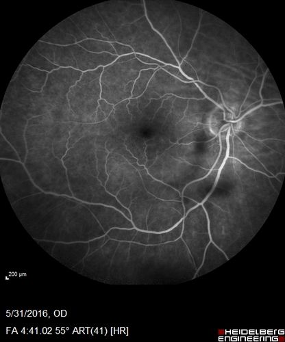 Branch Retinal Vein Occlusion (BRVO) no macular edema - cotton wool spot
85 year old man with asymptomatic BRVO - his vision stayed great without needing any treatment.
