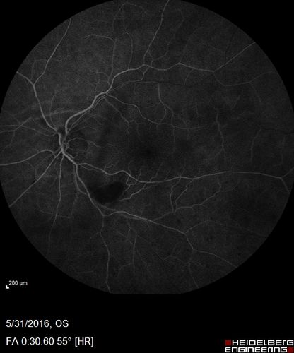 Branch Retinal Vein Occlusion (BRVO) no macular edema - cotton wool spot
85 year old man with asymptomatic BRVO - his vision stayed great without needing any treatment.
