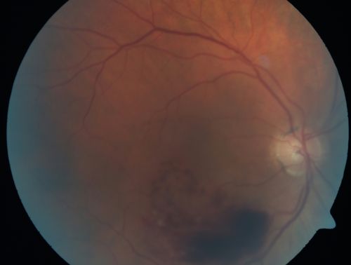 Branch Retinal Vein Occlusion with worse macular edema from hypertension - Photo from 2008 with initial occlusion - Vision 20/40
