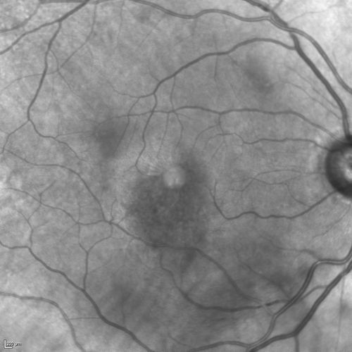 Branch Retinal Vein Occlusion with worse macular edema from hypertension - IR Photo from 2014 - vision 20/40
