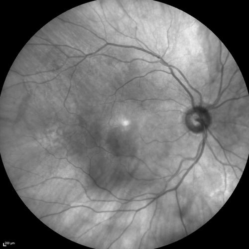 Branch Retinal Vein Occlusion with worse macular edema from hypertension - Photo from 2014 - vision 20/40
