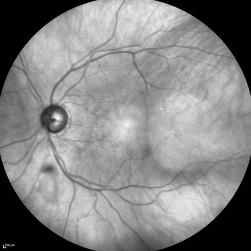 Branch Retinal Vein Occlusion with worse macular edema from hypertension - Photo from 2014 - vision 20/40

