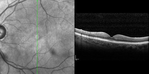 Branch Retinal Vein Occlusion with worse macular edema from hypertension - SD-OCT shows Edema Right Eye
