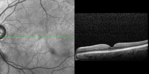 Branch Retinal Vein Occlusion with worse macular edema from hypertension - SD-OCT shows Edema Right Eye
