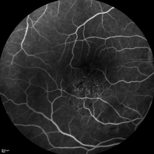 Branch Retinal Vein Occlusion with worse macular edema from hypertension - FA shows Edema Right Eye

