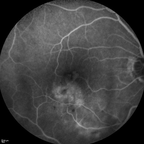 Branch Retinal Vein Occlusion with worse macular edema from hypertension - FA shows Edema Right Eye
