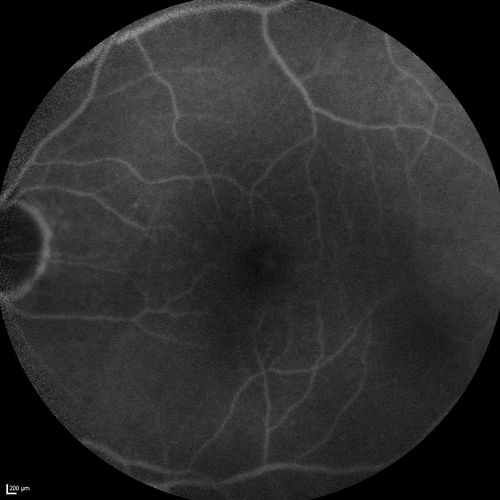 Branch Retinal Vein Occlusion with worse macular edema from hypertension - FA shows Edema Right Eye
