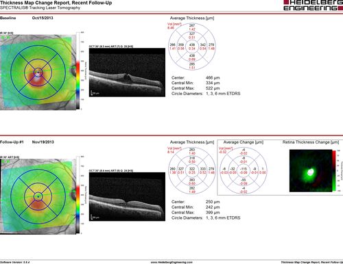 Branch Retinal Vein Occlusion with worse macular edema from hypertension - 1 month later - edema is less
Vision back to 20/25 with resolved edema (no need for other therapy with better blood pressure control)
