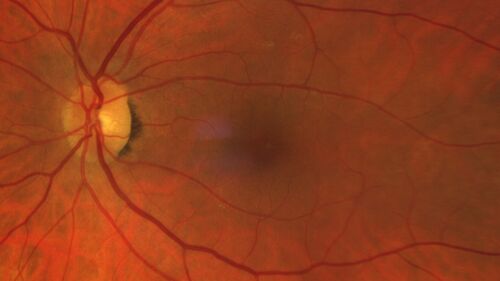 Twig (Macular) Branch Retinal Vein Occlusion with no symptoms
73 year old female with 20/25 vision and no symptoms
