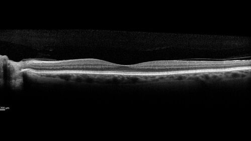 Twig (Macular) Branch Retinal Vein Occlusion with no symptoms
73 year old female with 20/25 vision and no symptoms
