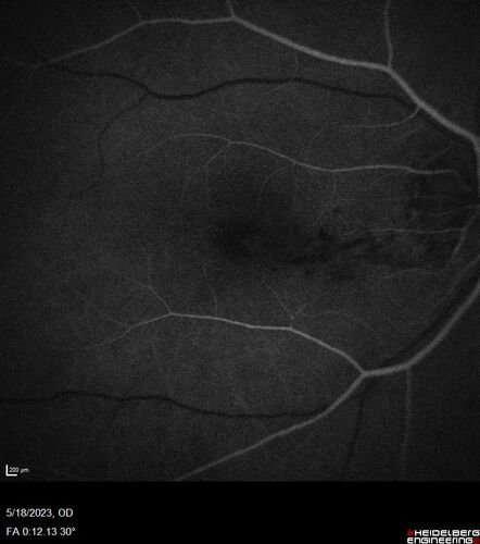 Twig (Macular) Branch Retinal Vein Occlusion with no symptoms
73 year old female with 20/25 vision and no symptoms
