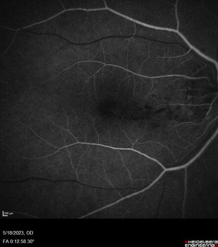 Twig (Macular) Branch Retinal Vein Occlusion with no symptoms
73 year old female with 20/25 vision and no symptoms
