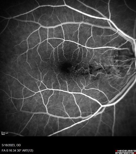 Twig (Macular) Branch Retinal Vein Occlusion with no symptoms
73 year old female with 20/25 vision and no symptoms
