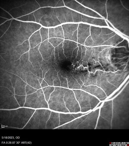 Twig (Macular) Branch Retinal Vein Occlusion with no symptoms
73 year old female with 20/25 vision and no symptoms
