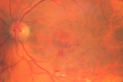 Branch Retinal Vein Occlusion
84 year old man - 2 months vision loss - VA 20/40 - 20/20 with one injection of Eylea
